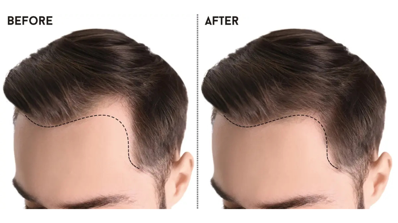 Hair Transplant: The Gold Standard for Hair Restoration