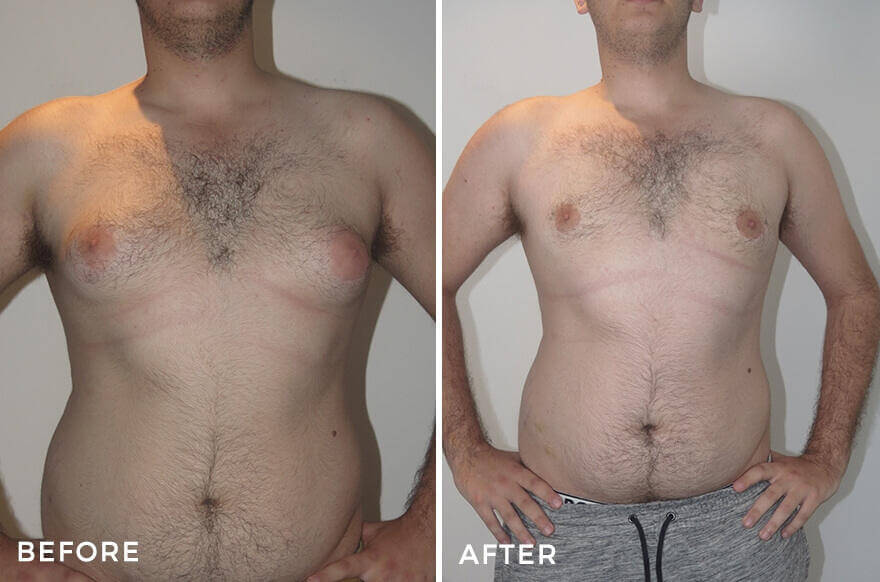 How to Get Rid of Gynecomastia: Causes, Exercises, and Surgery Options