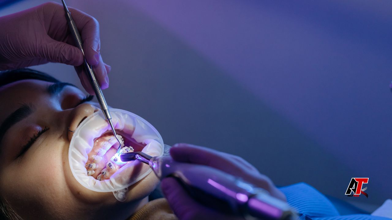 Dental Fillings